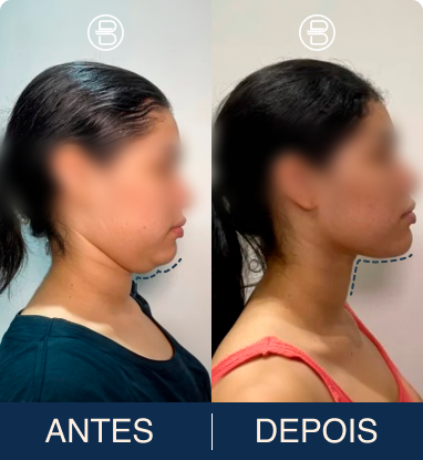 Transformação Caso Clínico 2 - Antes e Depois Lipo de Papada Dr. Bruno Noronha